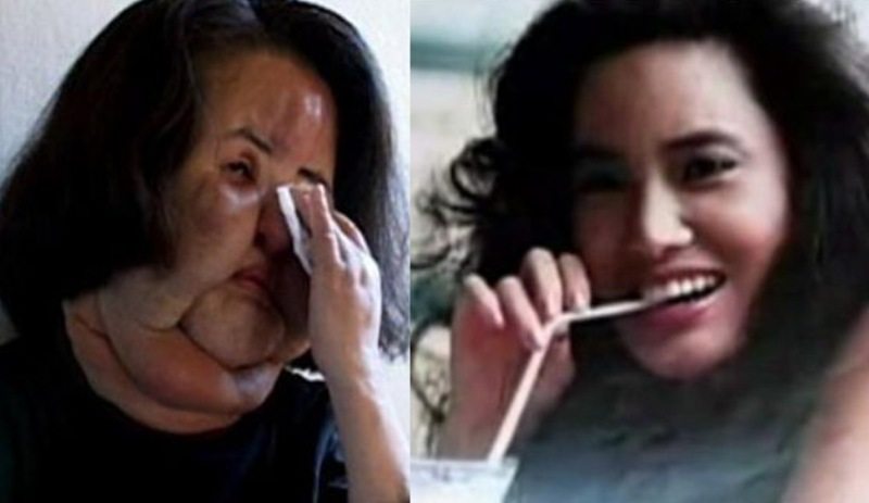 Plastic Surgery Horror Stories
