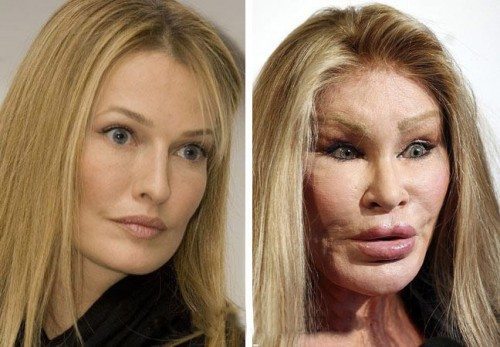 Plastic Surgery Horror Stories That Will Make You Change ...
