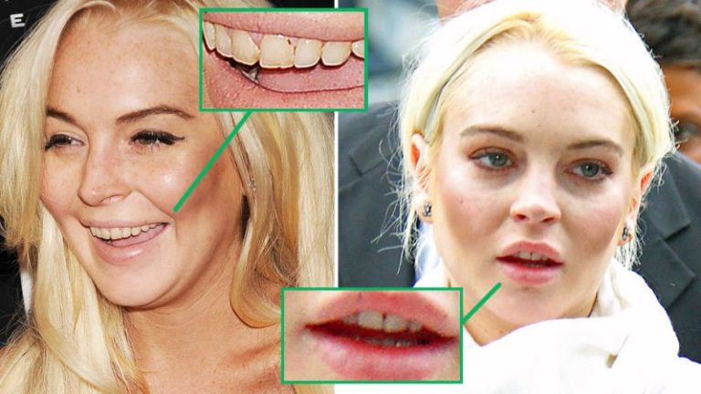Celebrities Who Went Through Teeth Surgery To Fix Their Gross Smiles